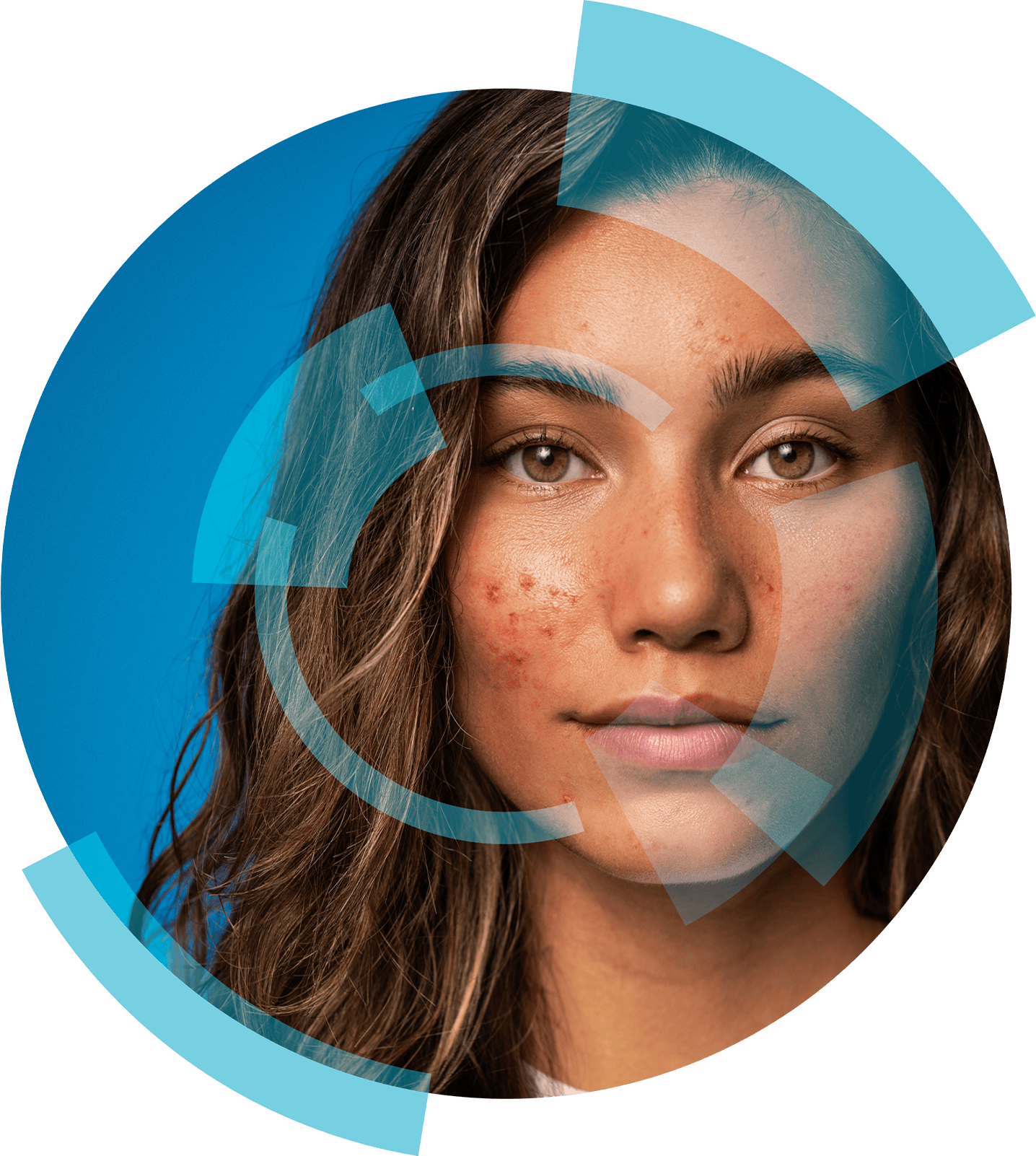 Late onset / Hormonal acne